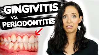 Do You Have Gingivitis or Periodontitis? | Different Stages Of Gum Disease