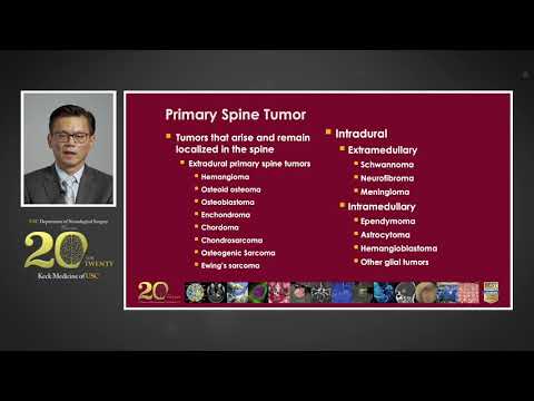 Surgical Management of Complex Spine Tumors