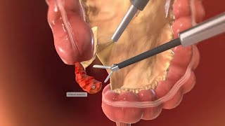 I filmed my APPENDECTOMY surgery (Graphic Content)