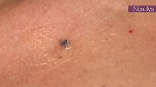 Resultado de tratamiento de puntos rubí con Nd: YAG 1064