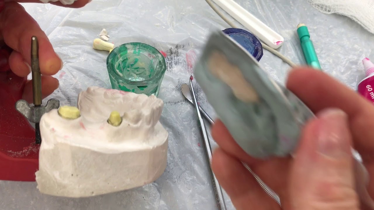 Confecção de coroa provisória de prótese fixa pela técnica de moldagem prévia