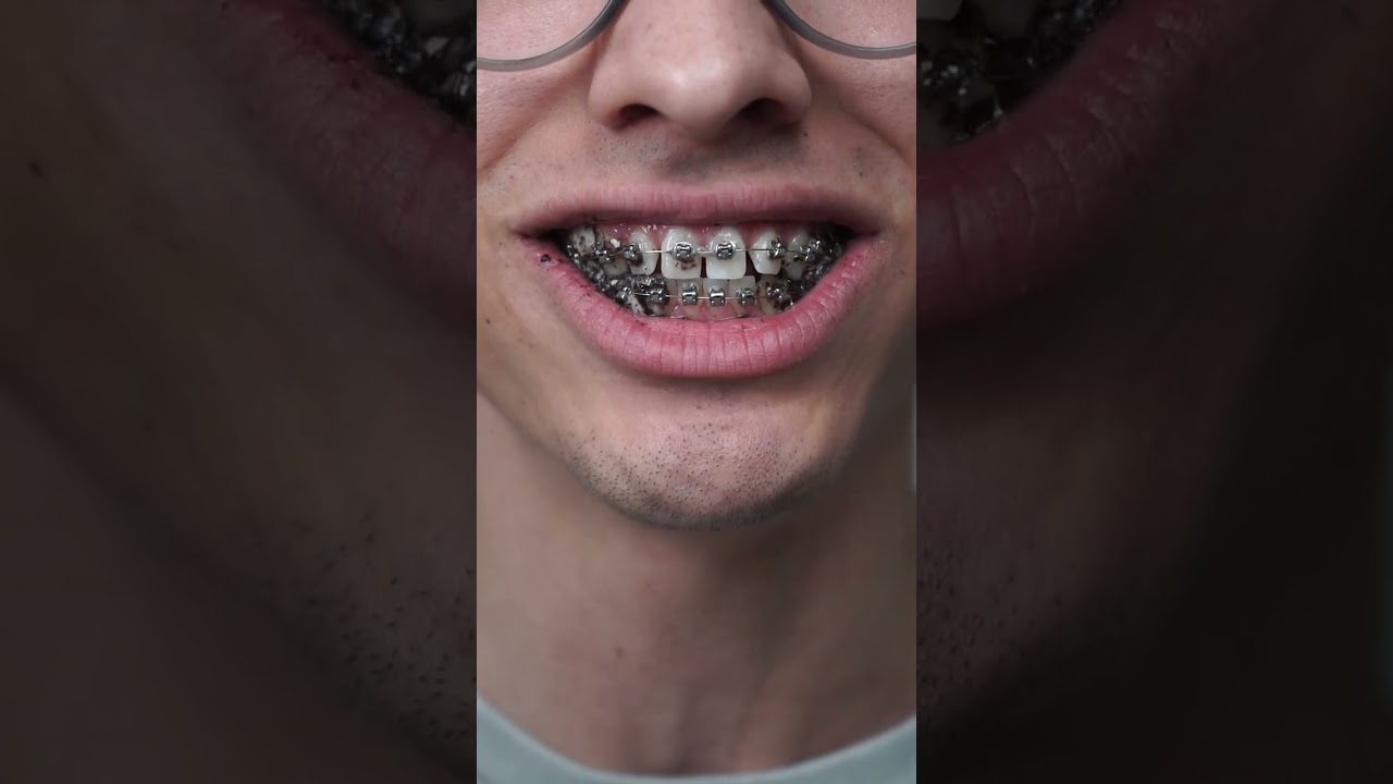 Oreos vs. braces