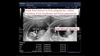 Single fetal demise in twin pregnancy, called Vanishing Twin Syndrome and Fetus papyraceus.