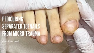 Pedicuring separated toenails due to micro trauma