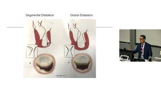 Mitral Valve Disease Secondary to Left Ventricular Dysfunction – Dr Levi Bassin