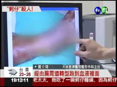 蚵仔未煮熟 老婦感染敗血不治