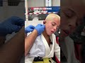 Getting my cauliflower ear drained #bjj #cauliflowerear