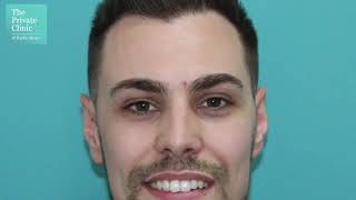 FUE Hair Transplant Patient Review - Steve