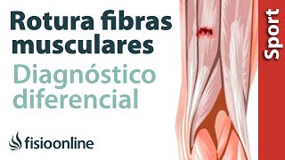 ¿Cómo diferenciar si tienes una rotura de fibras o una contractura o espasmo muscular