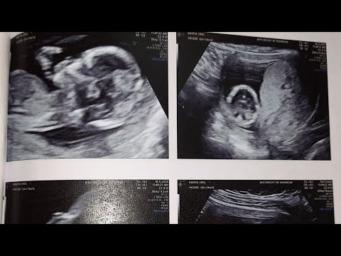 How To Do Tiffa Scan How To Do Tiffa Scan