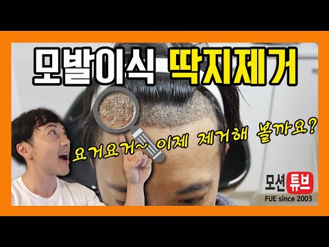 [비절개모발이식]2000모낭 모발이식 10일 후 딱지제거 방법 및 딱지제거 전후 비교