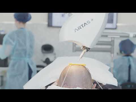 ARTAS iX Robotic Hair Transplant - "A day in the life" | The Derm Lab
