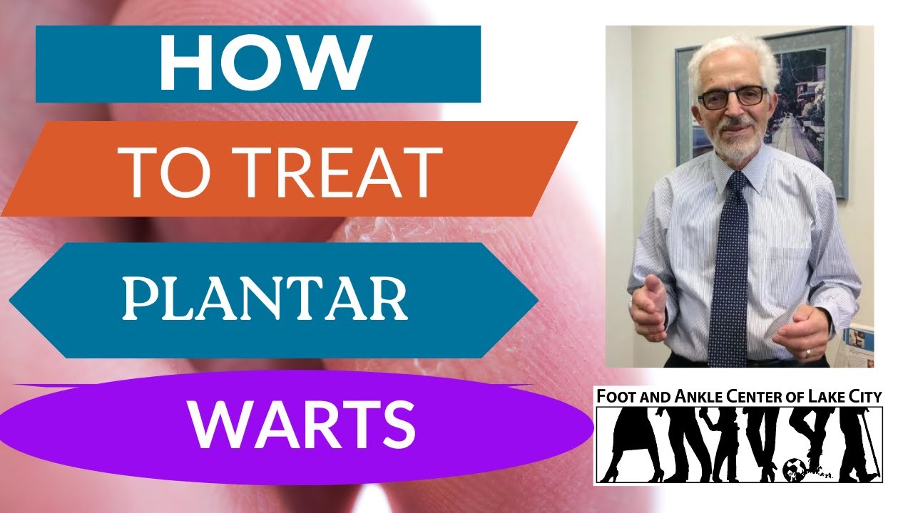 What Are Plantar Warts and How Are They Treated? Foot and Ankle