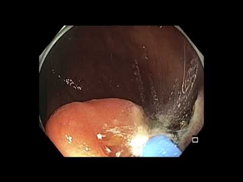 Colonoscopy: IC valve polyp