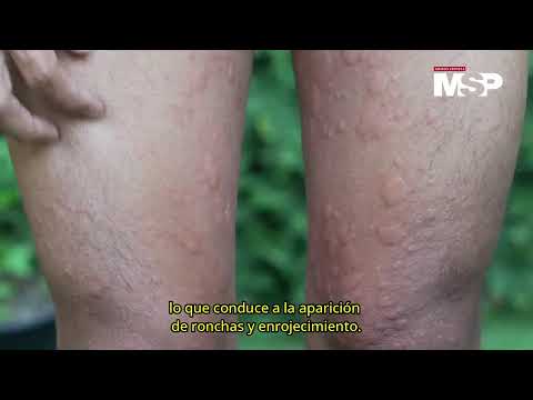 Día Mundial de la Urticaria: ¿Qué es y cómo funciona? - #ExclusivoMSP