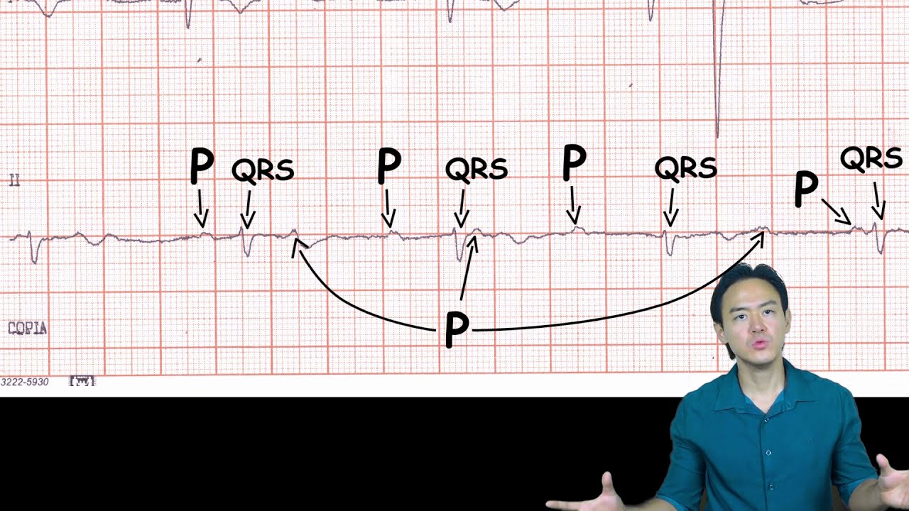Eletrocardiograma - análise - Bloqueio atrioventricular total
