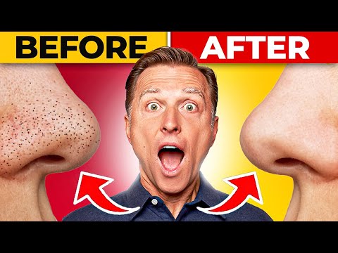 Which Vitamin Deficiency Causes Chapped Cracked Lips – Dr Berg