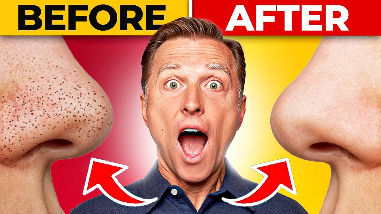 Get Rid of Your Blackheads the Natural Way, Beauty Vigour