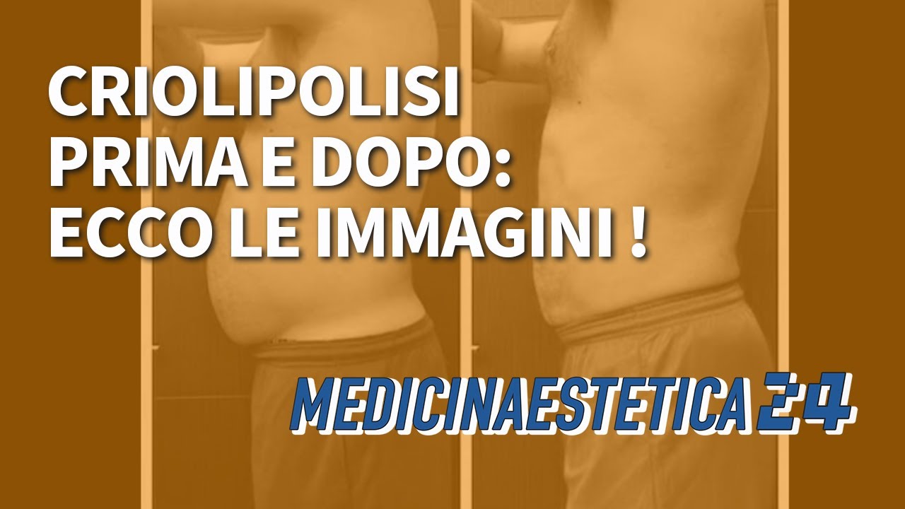 CRIOLIPOLISI PRIMA E DOPO: Ecco le immagini di numerosi Casi