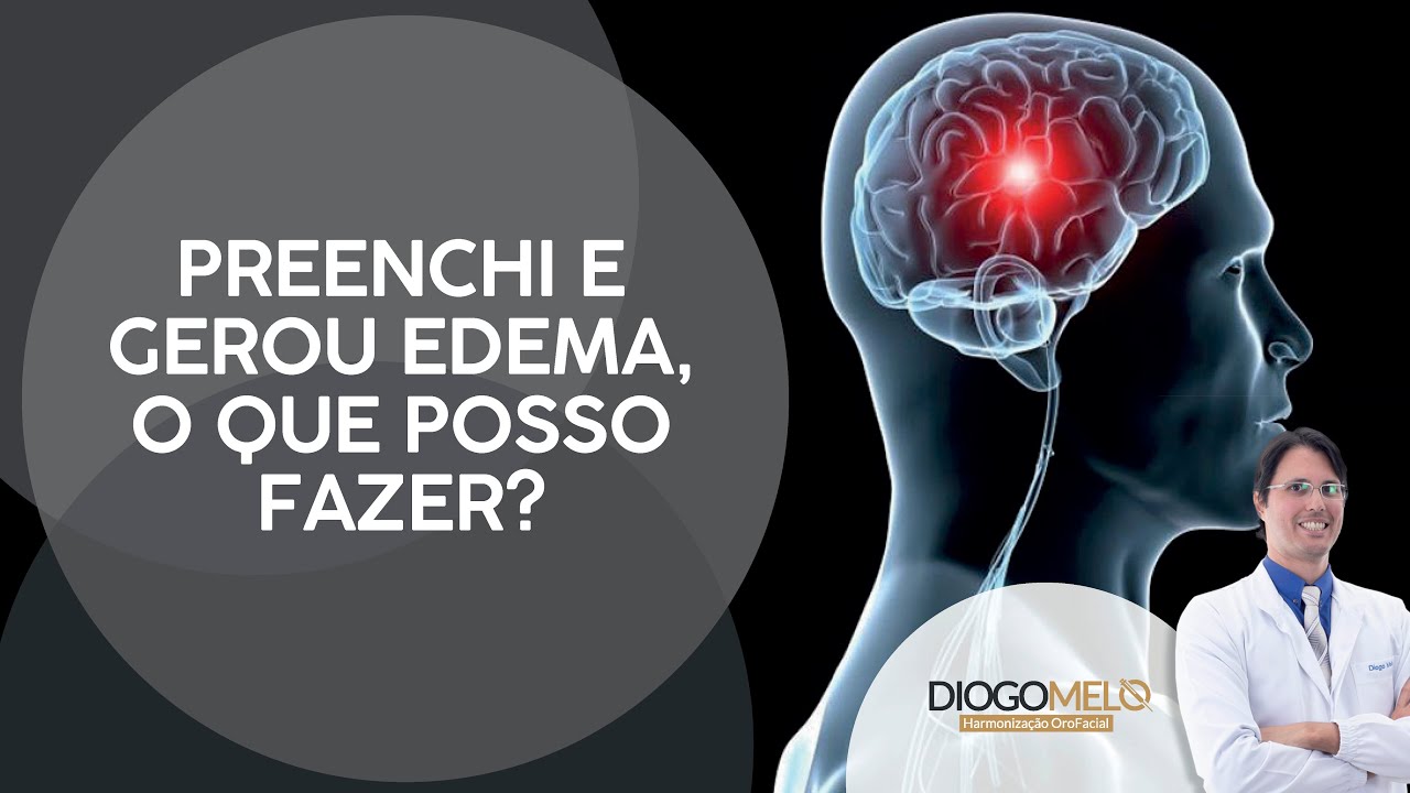 Fiz preenchimento no meu paciente gerou Edema (Ficou inchado)