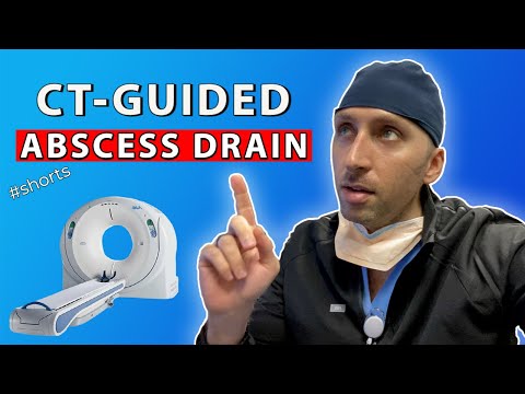 Emergent Abscess Drainage in under 30sec - Interventional Radiology