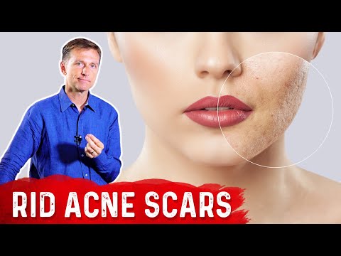 Best Way to Rid Acne Scars