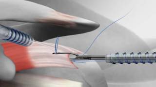 Rotator Cuff Repair with Arthrex® SutureBridge™