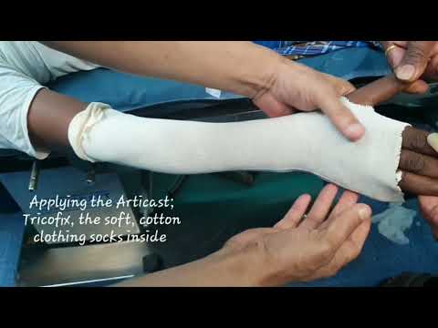 Fracture Lower end Radius | Communited fracture Radial Lower end | Closed reduction | Adamya Hosp Vd