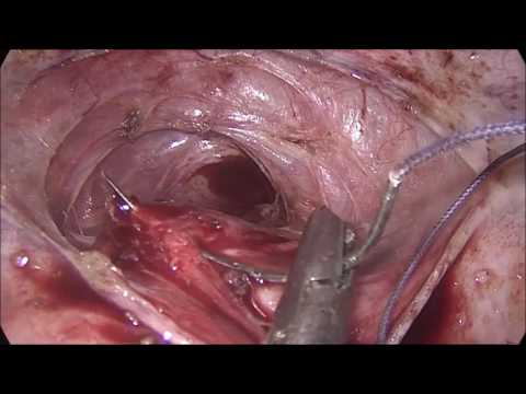 Successful Laparoscopic Uterovaginal Anastomosis For Cervical Agenesis