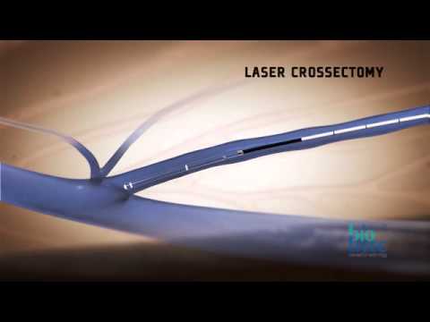 Σαφηνεκτομή με laser ELVeS Radial 2Ring - animation