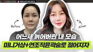 미니거상으로 되찾은 동안 얼굴! 4개월 변화 브이로그ㅣ디에이성형외과ㅣ디에이성형외과 의원