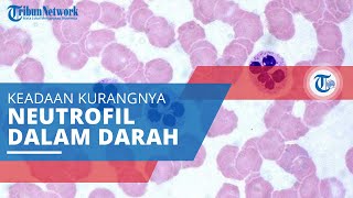 Neutropenia, Kondisi yang Terjadi ketika Seseorang Miliki Jumlah Neutrofil dalam Darah Sangat Rendah