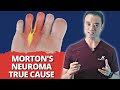 Everything You Know About Morton’s Neuroma Is WRONG! *Surprising True CAUSES Revealed*