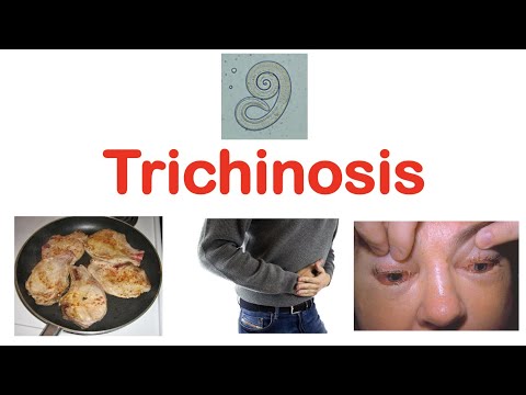 , title : 'Trichinosis (Pork Parasite) | Pathophysiology, Signs & Symptoms, Diagnosis, Treatment'