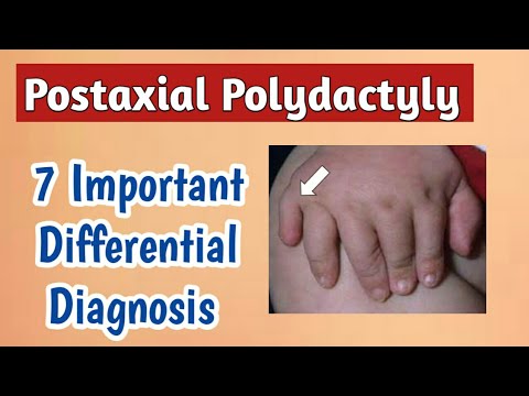 Postaxial Polydactyly Causes | Pediatrics Hand Dysmorphism - Part 1