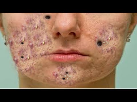 удаление прыщей уха уход за кожей#001