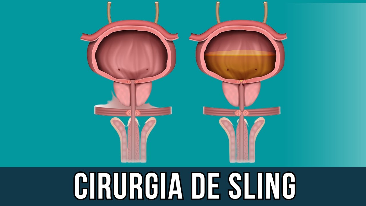 Cuidados antes e depois da cirurgia de Sling para incontinência urinária