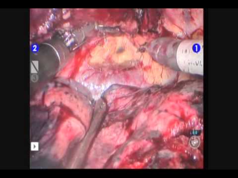 Total Robotic  Esophagogastrectomy With Lymph Node Dissection