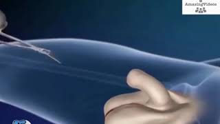 Thailand style of transgender surgery video