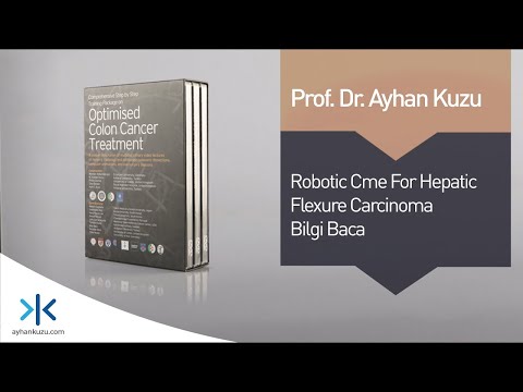 3.1.6. Robotic CME for Hepatic Flexura Carcinoma - Bilgi Baca