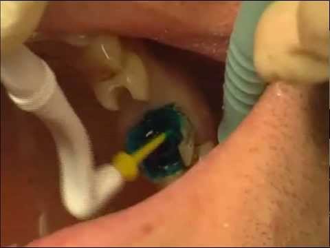La faccia di decolorazione fa i bagagli su crema aspra Su una retina notano il posto di pigmentary