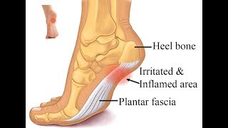 2 minute stretch to Cure Plantar Fasciitis