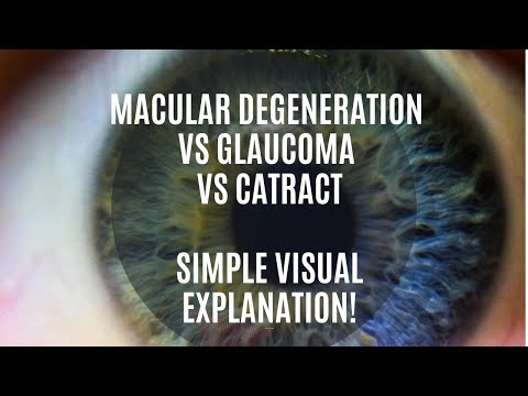 What Does Glaucoma, Macular Degeneration, Cataract, or Diabetes Look Like? A Simple Visual Aid
