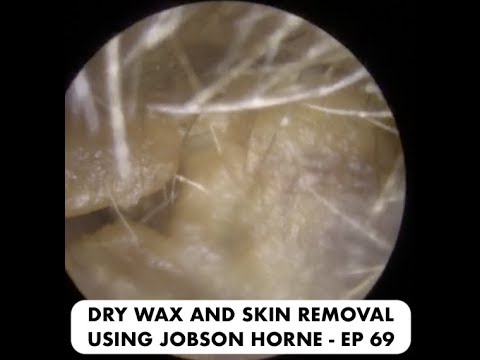 DRY SKIN AND EAR WAX REMOVAL USING JOBSON HORNE - EP 69