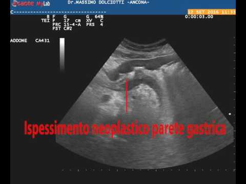 Dolore e gonfiore delle articolazioni della gamba Segni di colonna cervicale