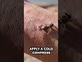 Bee Sting First Aid What To Do If You Ve Been Stung