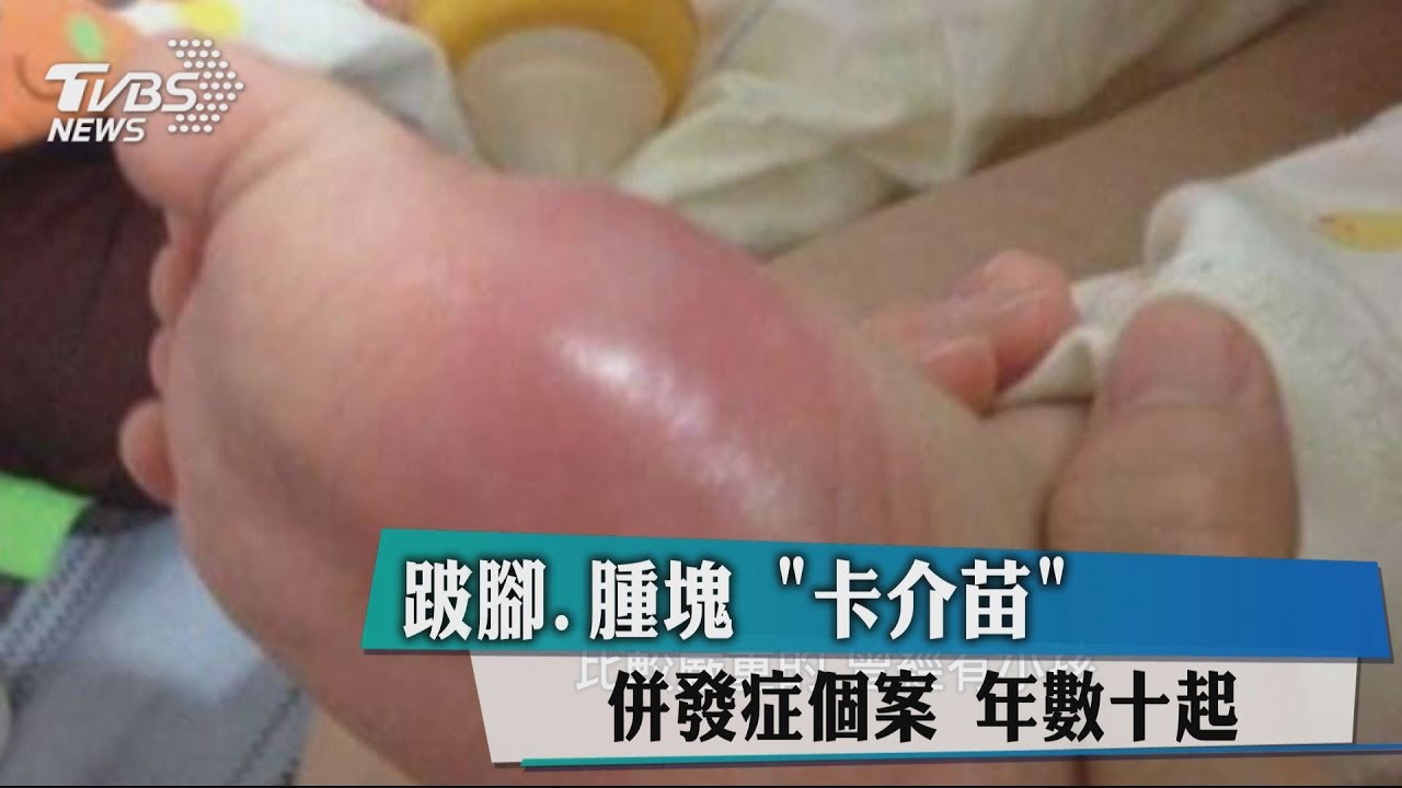 跛腳、腫塊！「卡介苗」併發症個案　年數十起