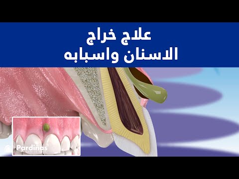 © علاج خراج الاسنان واسبابه