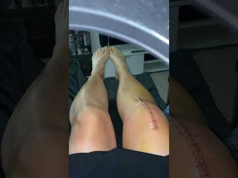 Tänään 5 päivää oikean polven tekonivel leikkauksesta.