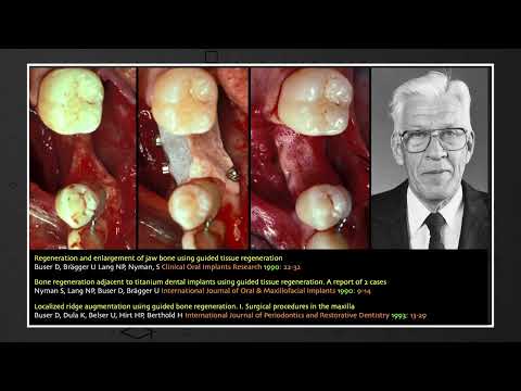 What did we learn in 30 years of implant dentistry?